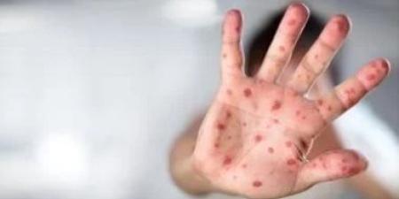 غانا تشهد أسوأ تفش لمرض جدري القرود منذ عام 2022